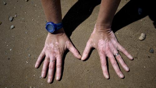 Santé : un premier traitement autorisé pour les sufferers atteints de vitiligo disponible en France